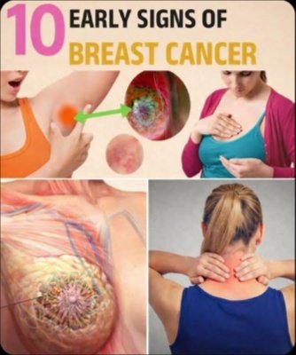 Shocking Truth: 10 Subtle Breast Cancer Signs You're Overlooking (And Why You Can't Afford To!)