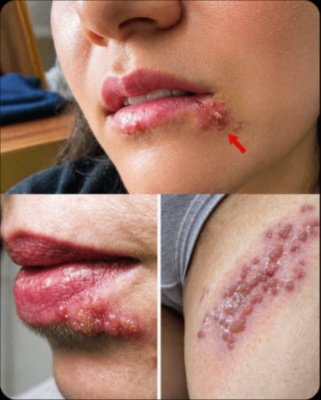 You're Missing This Crucial Clue! Why Recurrent Lip/Private Area Blisters Keep Coming Back (and 5 Ways to End Them)