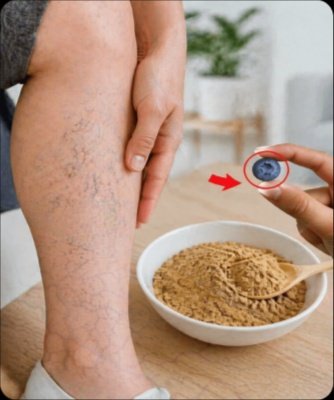 Sick of Achy Legs? 10 Shocking Natural Hacks to Reverse Varicose Vein Discomfort & Skyrocket Your Blood Flow!