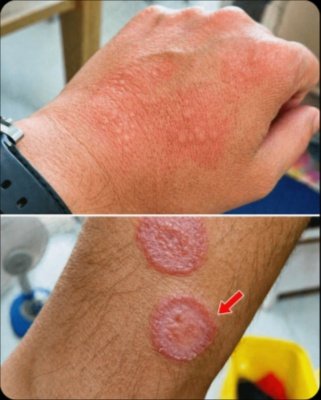 The ONE Warning Sign Your Red Circular Rash Is Ringworm (And How To Stop It Spreading FAST!)