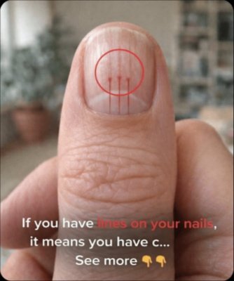 The Secret Language of Your Fingernails: What Those Lines REALLY Reveal About Your Health (And When To Act Fast!)
