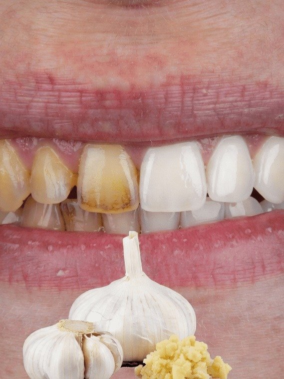 Unlock a Dazzling Smile in 2 Minutes: This Viral Garlic Hack Could Erase 10 Years of Tooth Stains!