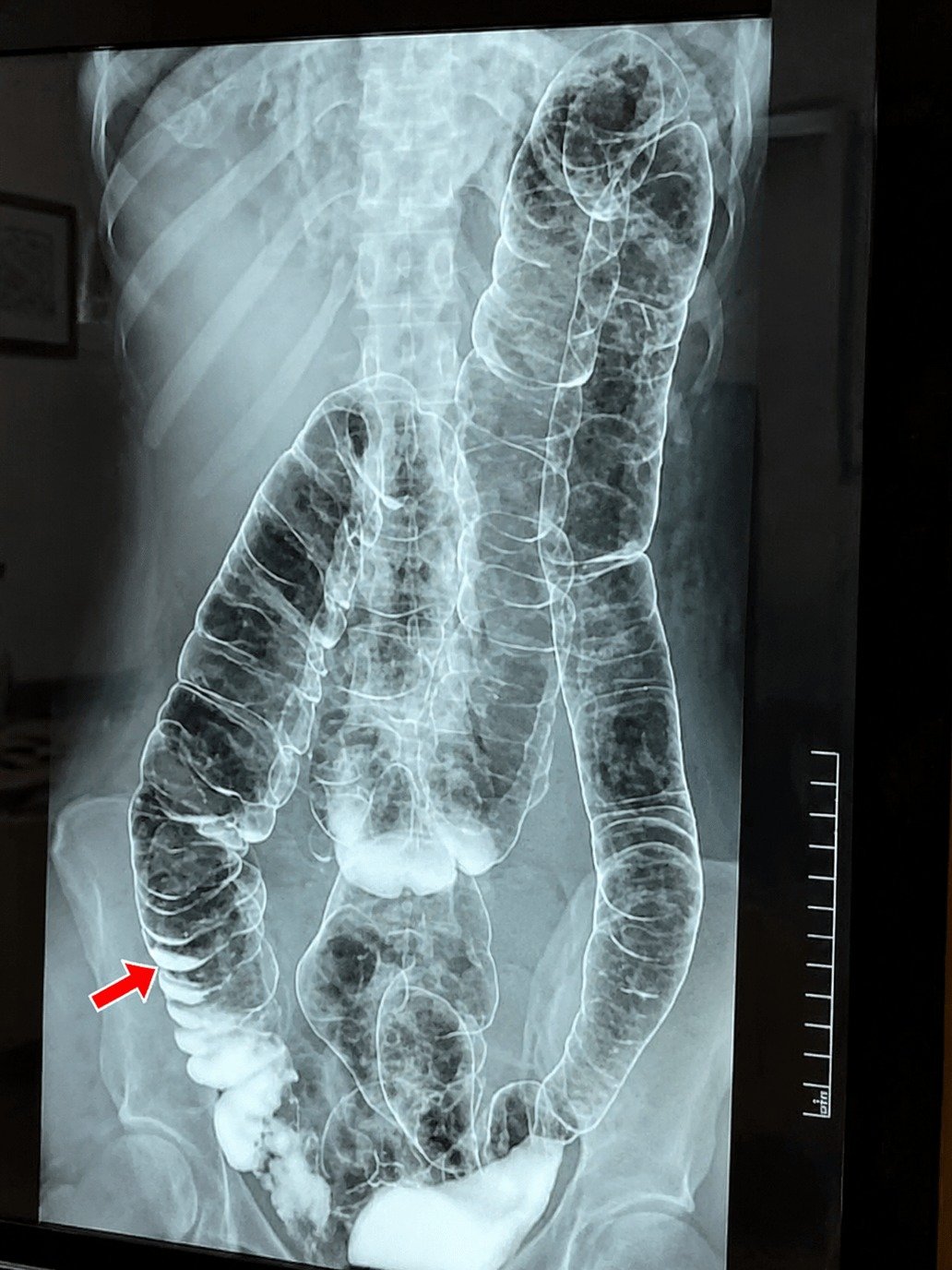 Your Chronic Constipation Could Be a Silent Killer: 5 Urgent Warning Signs of Toxic Megacolon You Need to Know NOW
